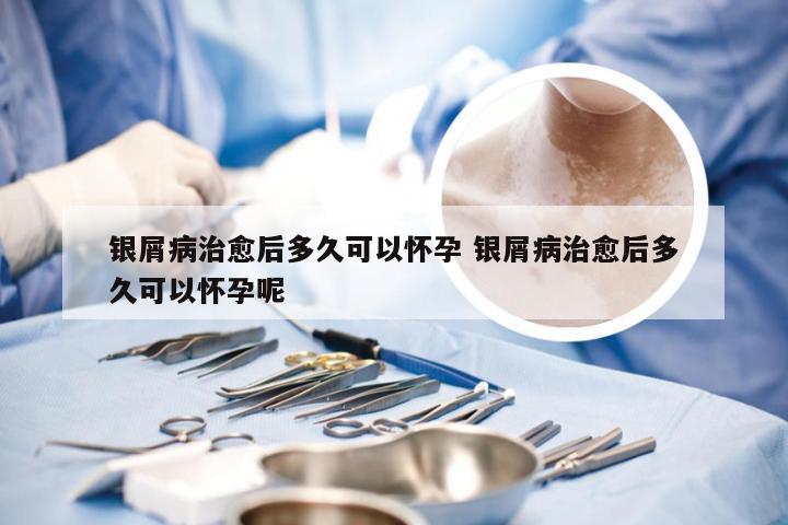 银屑病治愈后多久可以怀孕 银屑病治愈后多久可以怀孕呢