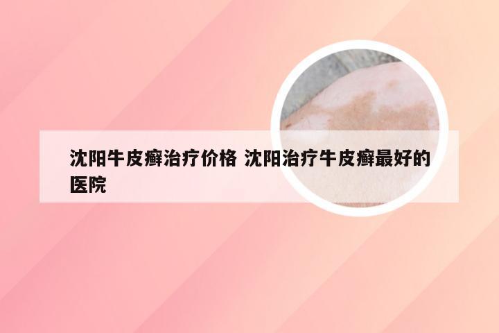 沈阳牛皮癣治疗价格 沈阳治疗牛皮癣最好的医院