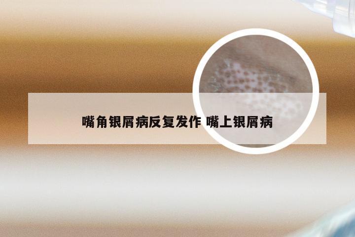 嘴角银屑病反复发作 嘴上银屑病
