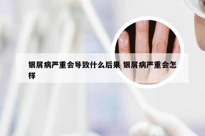 银屑病严重会导致什么后果 银屑病严重会怎样