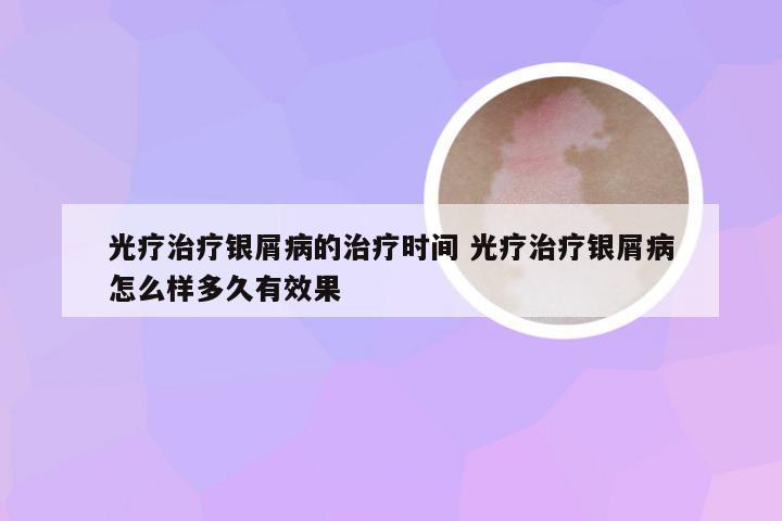 光疗治疗银屑病的治疗时间 光疗治疗银屑病怎么样多久有效果
