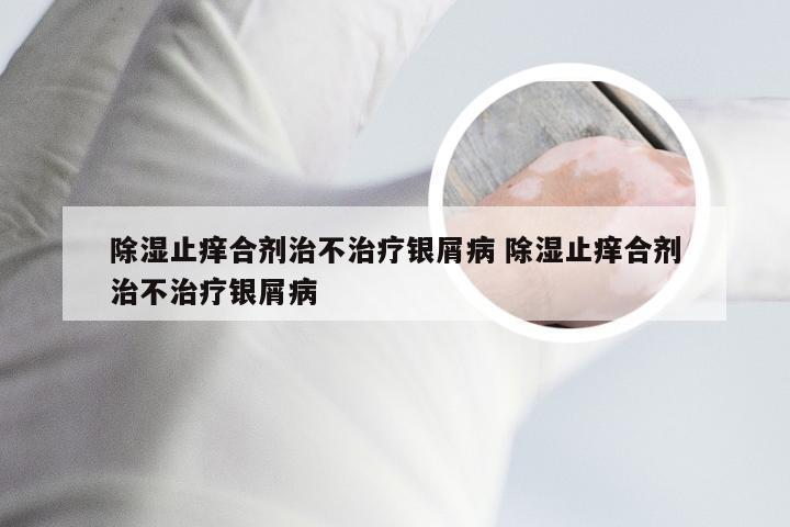 除湿止痒合剂治不治疗银屑病 除湿止痒合剂治不治疗银屑病