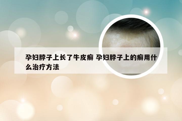 孕妇脖子上长了牛皮癣 孕妇脖子上的癣用什么治疗方法