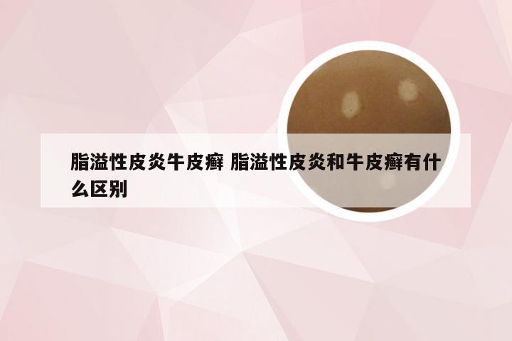 脂溢性皮炎牛皮癣 脂溢性皮炎和牛皮癣有什么区别