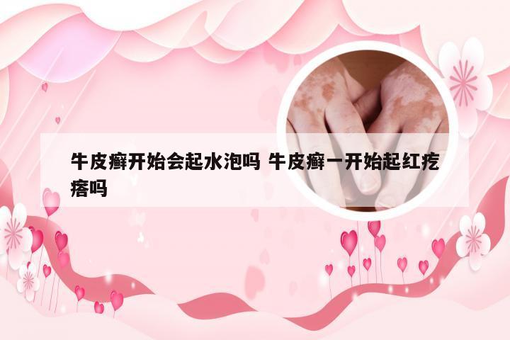 牛皮癣开始会起水泡吗 牛皮癣一开始起红疙瘩吗