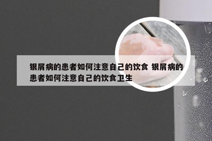 银屑病的患者如何注意自己的饮食 银屑病的患者如何注意自己的饮食卫生