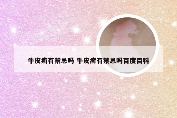 牛皮癣有禁忌吗 牛皮癣有禁忌吗百度百科