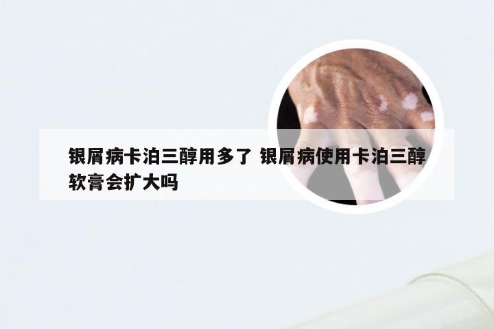 银屑病卡泊三醇用多了 银屑病使用卡泊三醇软膏会扩大吗