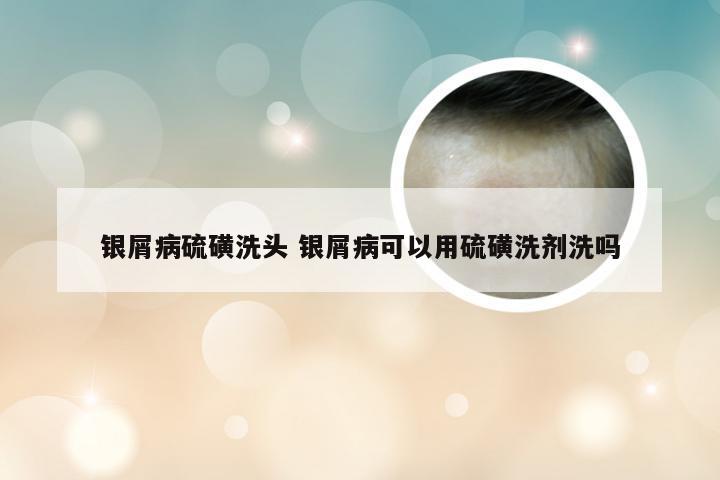 银屑病硫磺洗头 银屑病可以用硫磺洗剂洗吗
