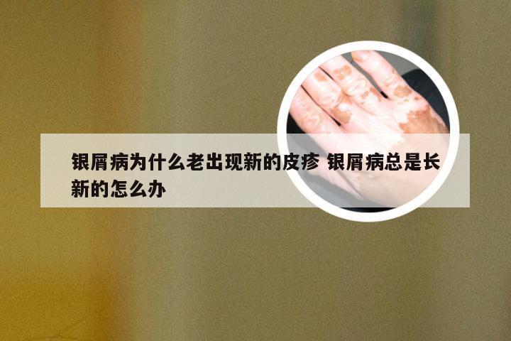 银屑病为什么老出现新的皮疹 银屑病总是长新的怎么办
