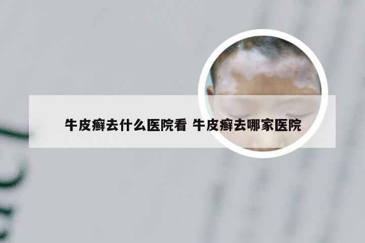 牛皮癣去什么医院看 牛皮癣去哪家医院