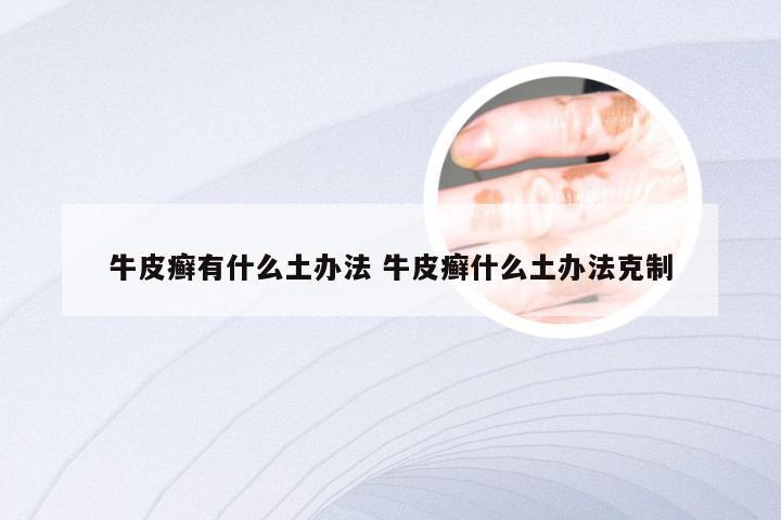 牛皮癣有什么土办法 牛皮癣什么土办法克制