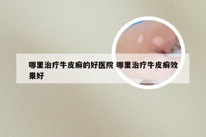 哪里治疗牛皮癣的好医院 哪里治疗牛皮癣效果好