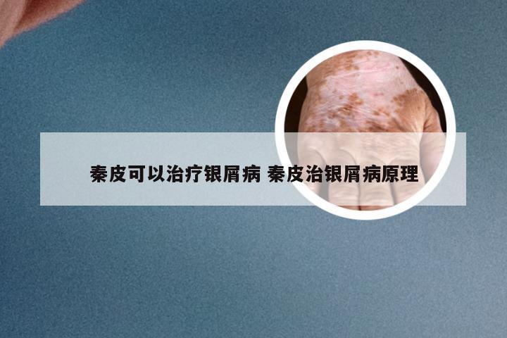 秦皮可以治疗银屑病 秦皮治银屑病原理