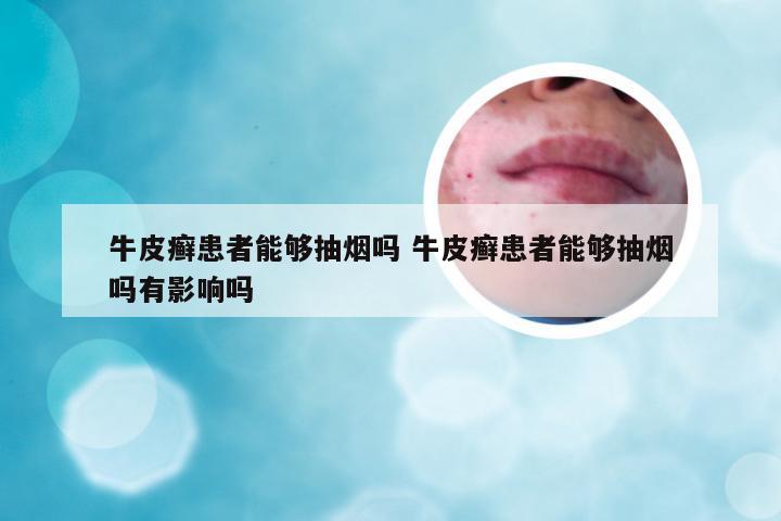 牛皮癣患者能够抽烟吗 牛皮癣患者能够抽烟吗有影响吗