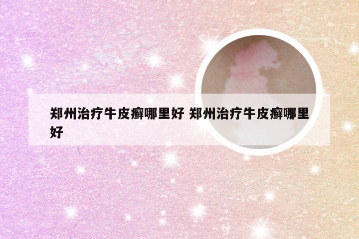 郑州治疗牛皮癣哪里好 郑州治疗牛皮癣哪里好
