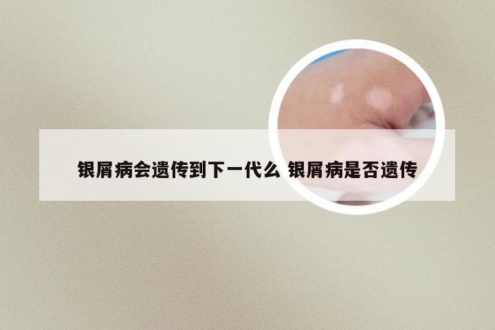 银屑病会遗传到下一代么 银屑病是否遗传