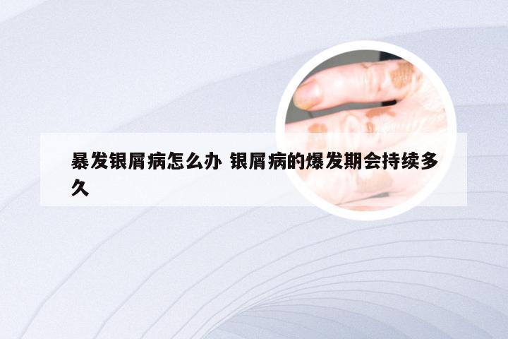 暴发银屑病怎么办 银屑病的爆发期会持续多久