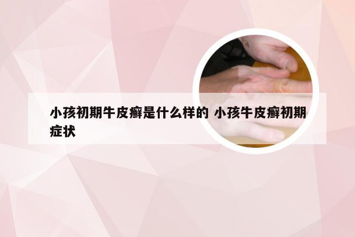 小孩初期牛皮癣是什么样的 小孩牛皮癣初期症状
