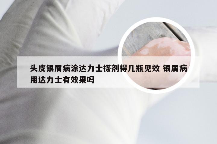 头皮银屑病涂达力士搽剂得几瓶见效 银屑病用达力士有效果吗