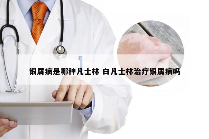 银屑病是哪种凡士林 白凡士林治疗银屑病吗