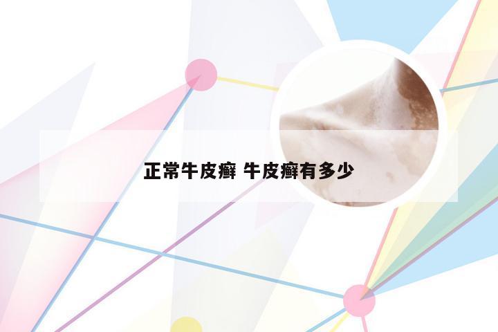 正常牛皮癣 牛皮癣有多少