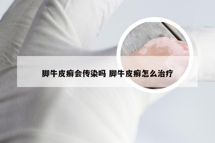 脚牛皮癣会传染吗 脚牛皮癣怎么治疗