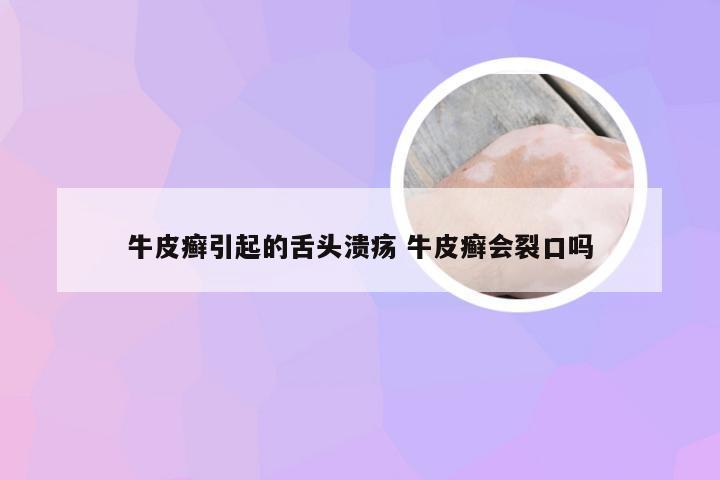 牛皮癣引起的舌头溃疡 牛皮癣会裂口吗