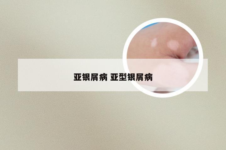 亚银屑病 亚型银屑病