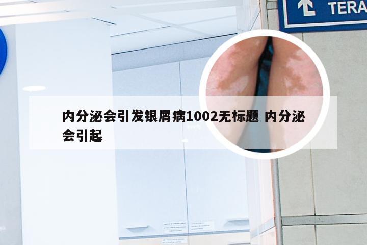 内分泌会引发银屑病1002无标题 内分泌会引起