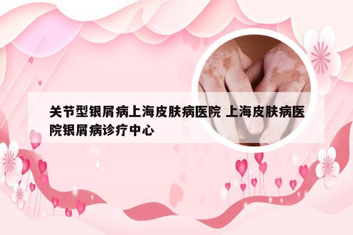 关节型银屑病上海皮肤病医院 上海皮肤病医院银屑病诊疗中心