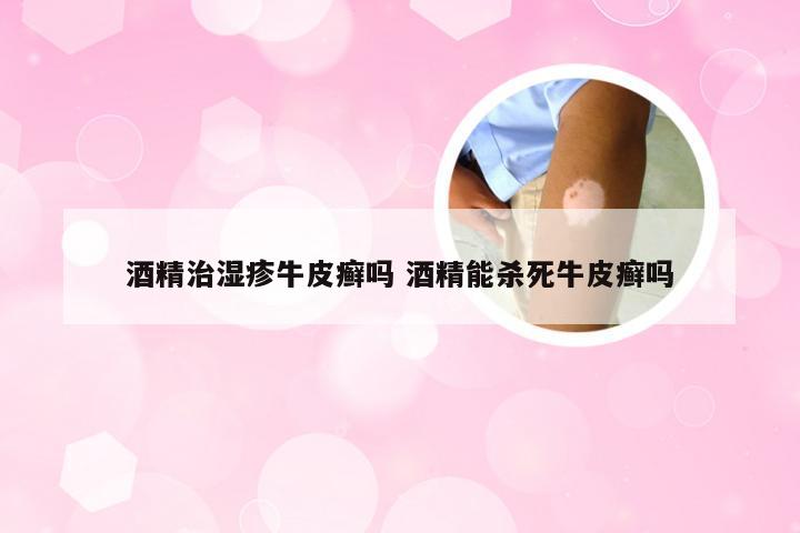 酒精治湿疹牛皮癣吗 酒精能杀死牛皮癣吗