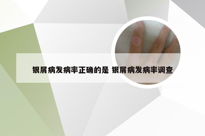 银屑病发病率正确的是 银屑病发病率调查