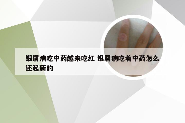 银屑病吃中药越来吃红 银屑病吃着中药怎么还起新的