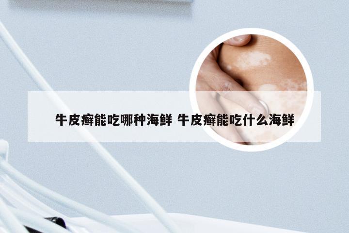 牛皮癣能吃哪种海鲜 牛皮癣能吃什么海鲜