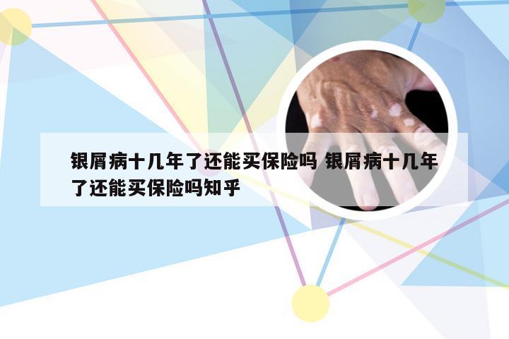 银屑病十几年了还能买保险吗 银屑病十几年了还能买保险吗知乎