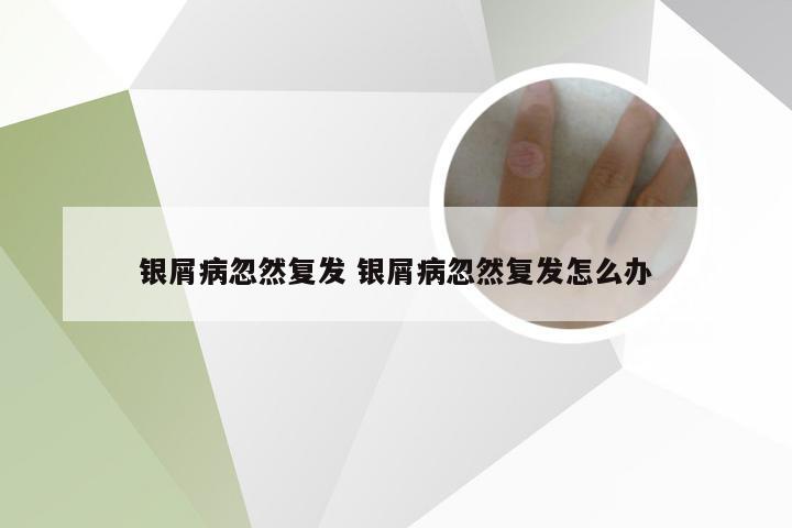 银屑病忽然复发 银屑病忽然复发怎么办