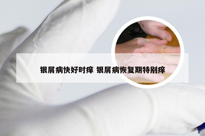 银屑病快好时痒 银屑病恢复期特别痒