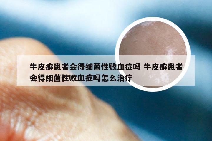牛皮癣患者会得细菌性败血症吗 牛皮癣患者会得细菌性败血症吗怎么治疗