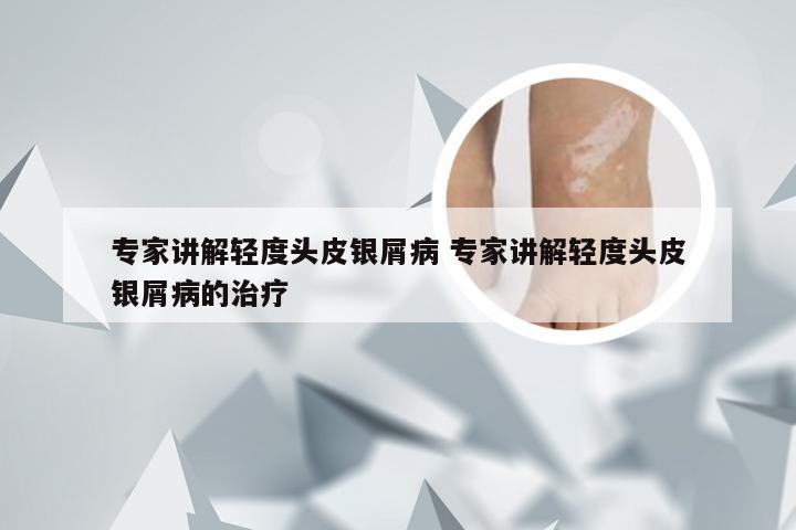 专家讲解轻度头皮银屑病 专家讲解轻度头皮银屑病的治疗