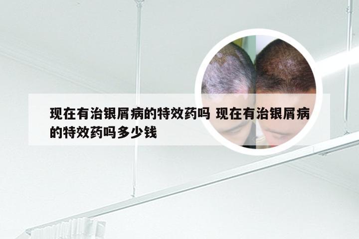 现在有治银屑病的特效药吗 现在有治银屑病的特效药吗多少钱