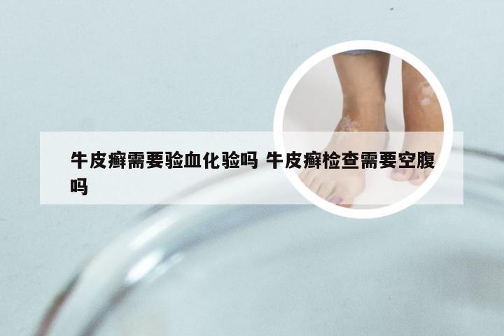 牛皮癣需要验血化验吗 牛皮癣检查需要空腹吗