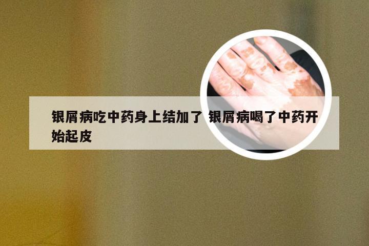银屑病吃中药身上结加了 银屑病喝了中药开始起皮