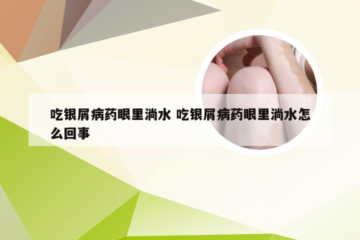吃银屑病药眼里淌水 吃银屑病药眼里淌水怎么回事