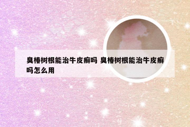 臭椿树根能治牛皮癣吗 臭椿树根能治牛皮癣吗怎么用
