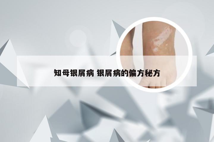 知母银屑病 银屑病的偏方秘方