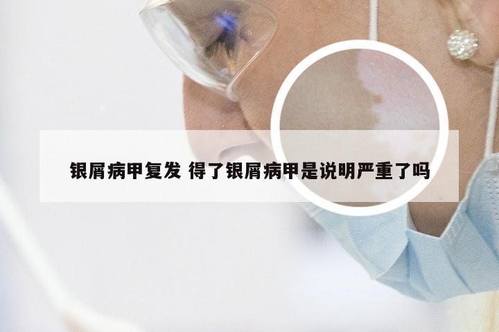 银屑病甲复发 得了银屑病甲是说明严重了吗