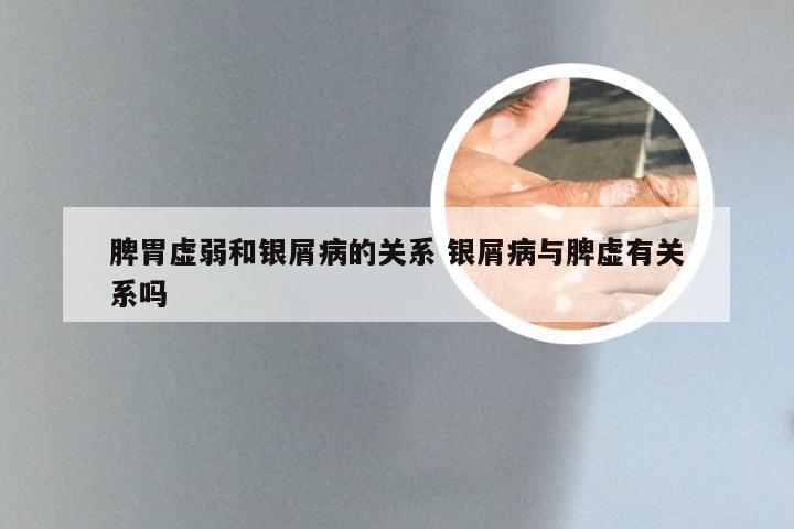 脾胃虚弱和银屑病的关系 银屑病与脾虚有关系吗