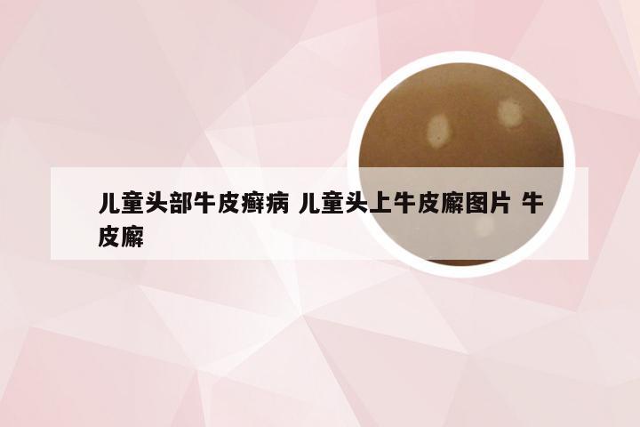 儿童头部牛皮癣病 儿童头上牛皮廨图片 牛皮廨