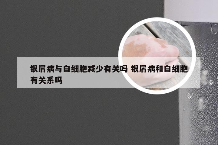 银屑病与白细胞减少有关吗 银屑病和白细胞有关系吗